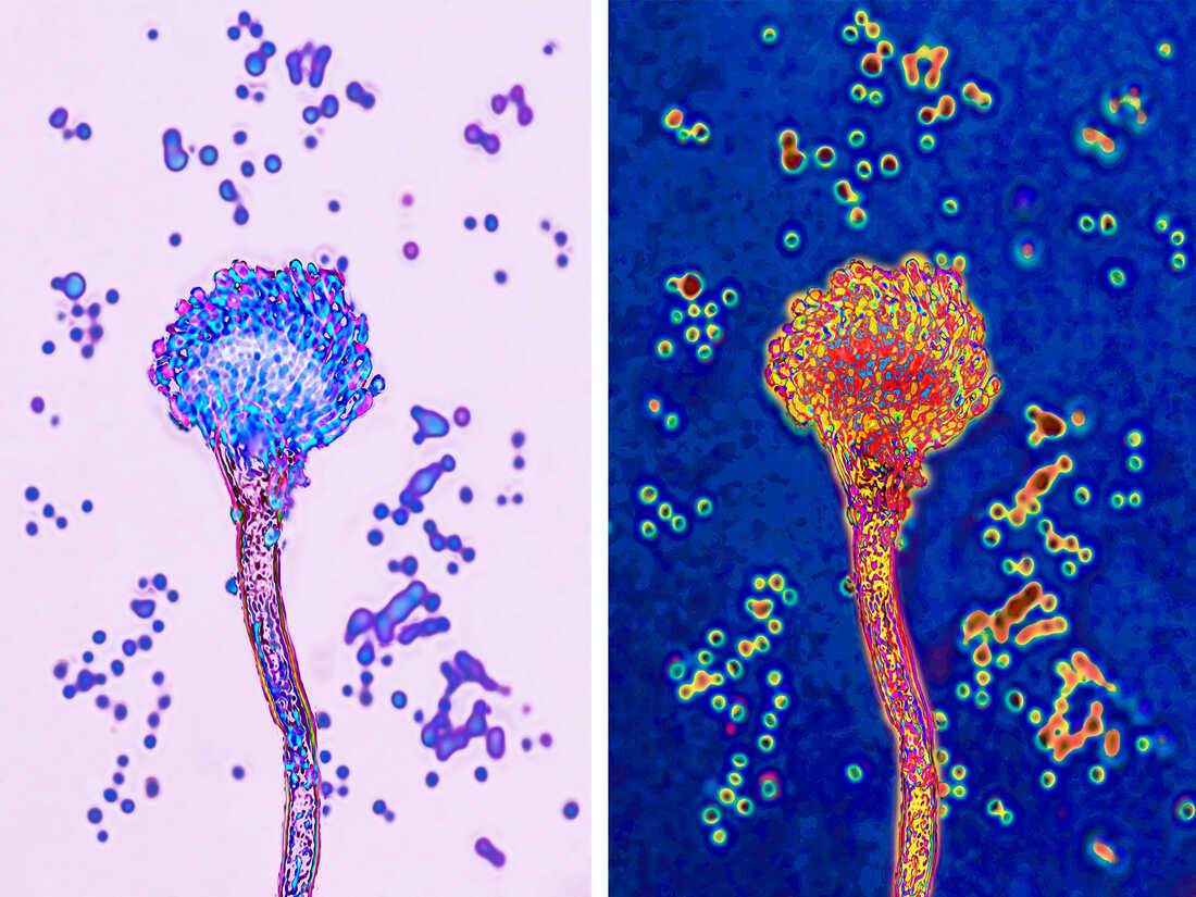 Are Deadly Fungi Fueling The Next Public Health Emergency? Are Deadly Fungi Fueling The Next Public Health Emergency?