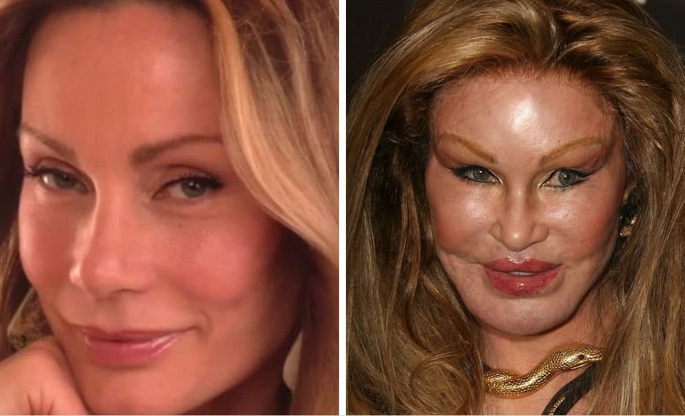 Facelift Backlash: When Cosmetic Surgery Goes Wrong Facelift Backlash: When Cosmetic Surgery Goes Wrong