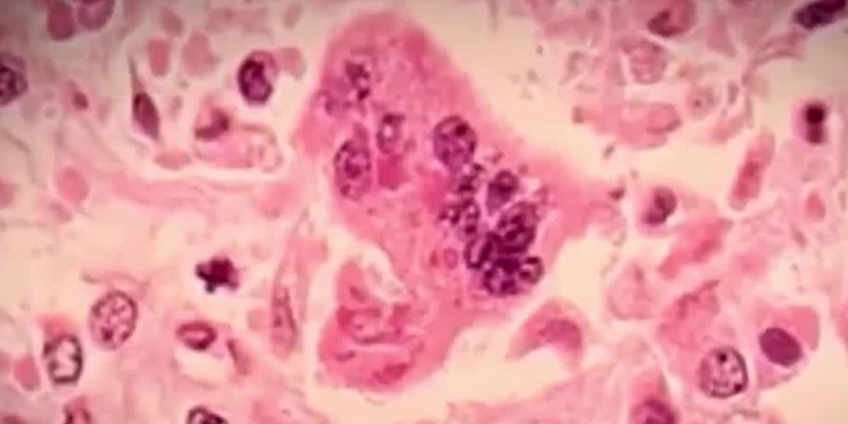 Investigating The Resurgence Of Measles Cases In Kansas Investigating The Resurgence Of Measles Cases In Kansas