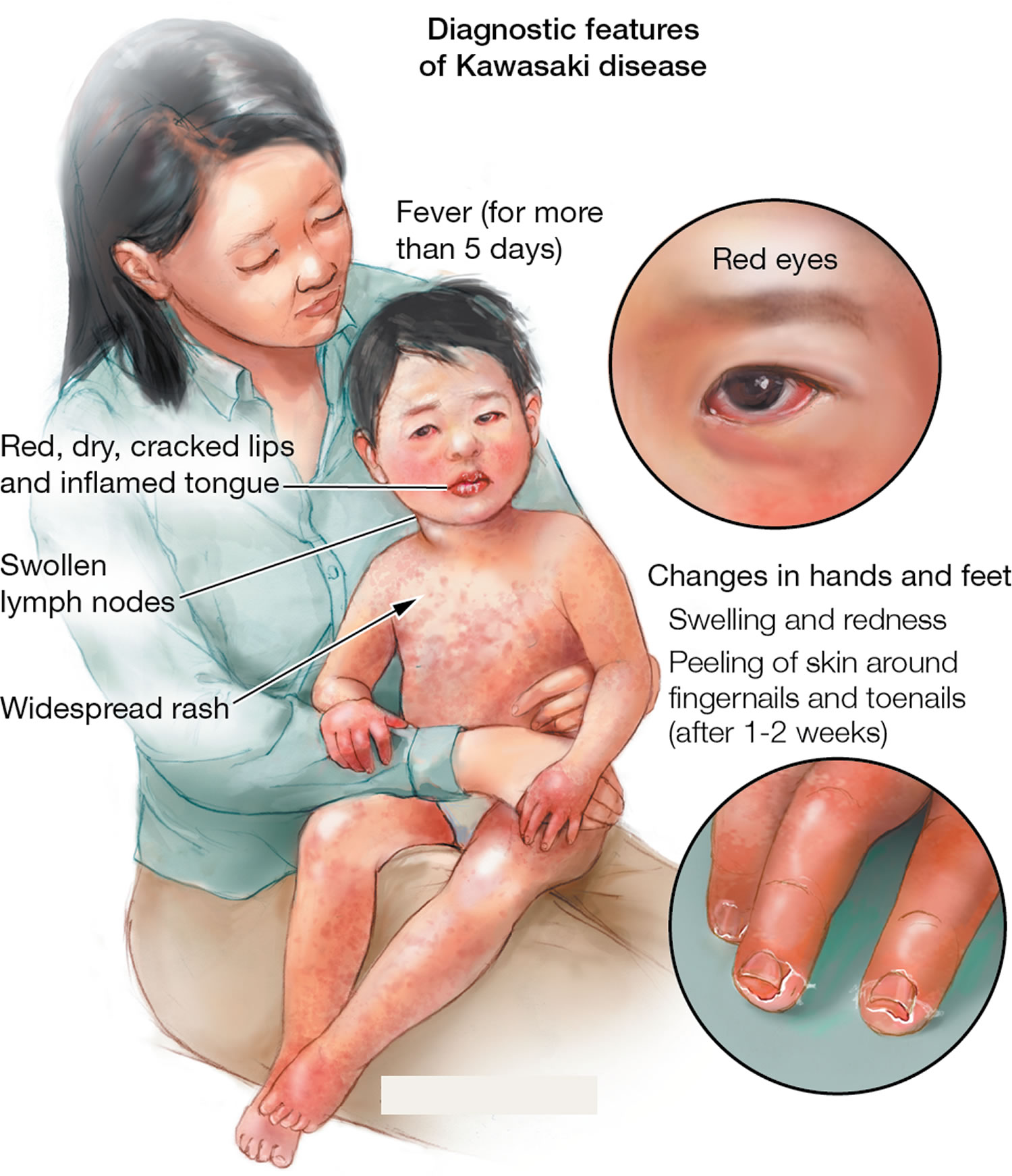 Is A Single, Unknown Respiratory Virus The Cause Of Kawasaki Disease? New Data Suggests So Is A Single, Unknown Respiratory Virus The Cause Of Kawasaki Disease? New Data Suggests So