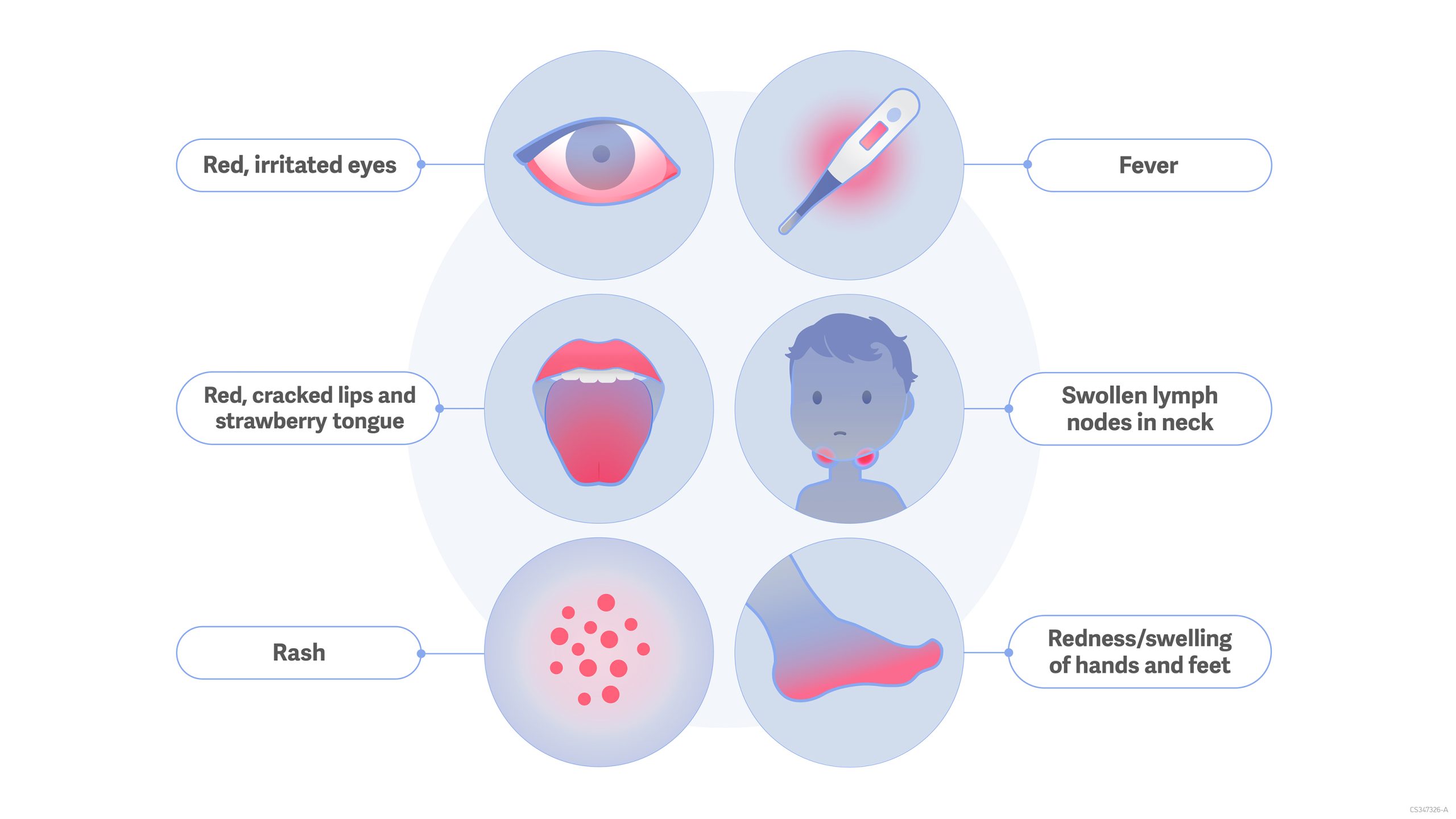 Kawasaki Disease: A Novel Respiratory Virus As The Culprit? Kawasaki Disease: A Novel Respiratory Virus As The Culprit?