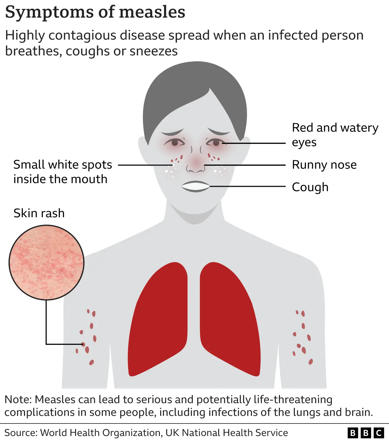 Latest Update: Six More Cases Of Measles Confirmed In Kansas Latest Update: Six More Cases Of Measles Confirmed In Kansas