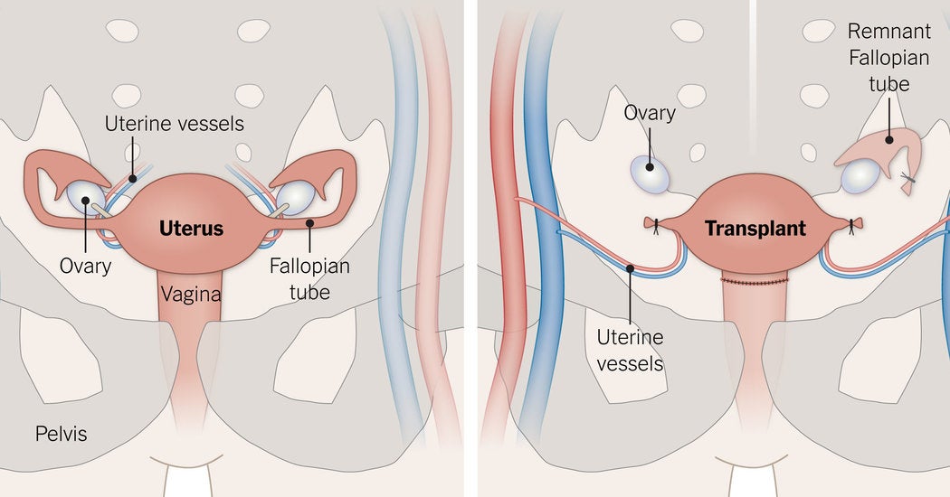 Live Uterus Transplants: A Community Activist's Proposal For Transgender Women Live Uterus Transplants: A Community Activist's Proposal For Transgender Women