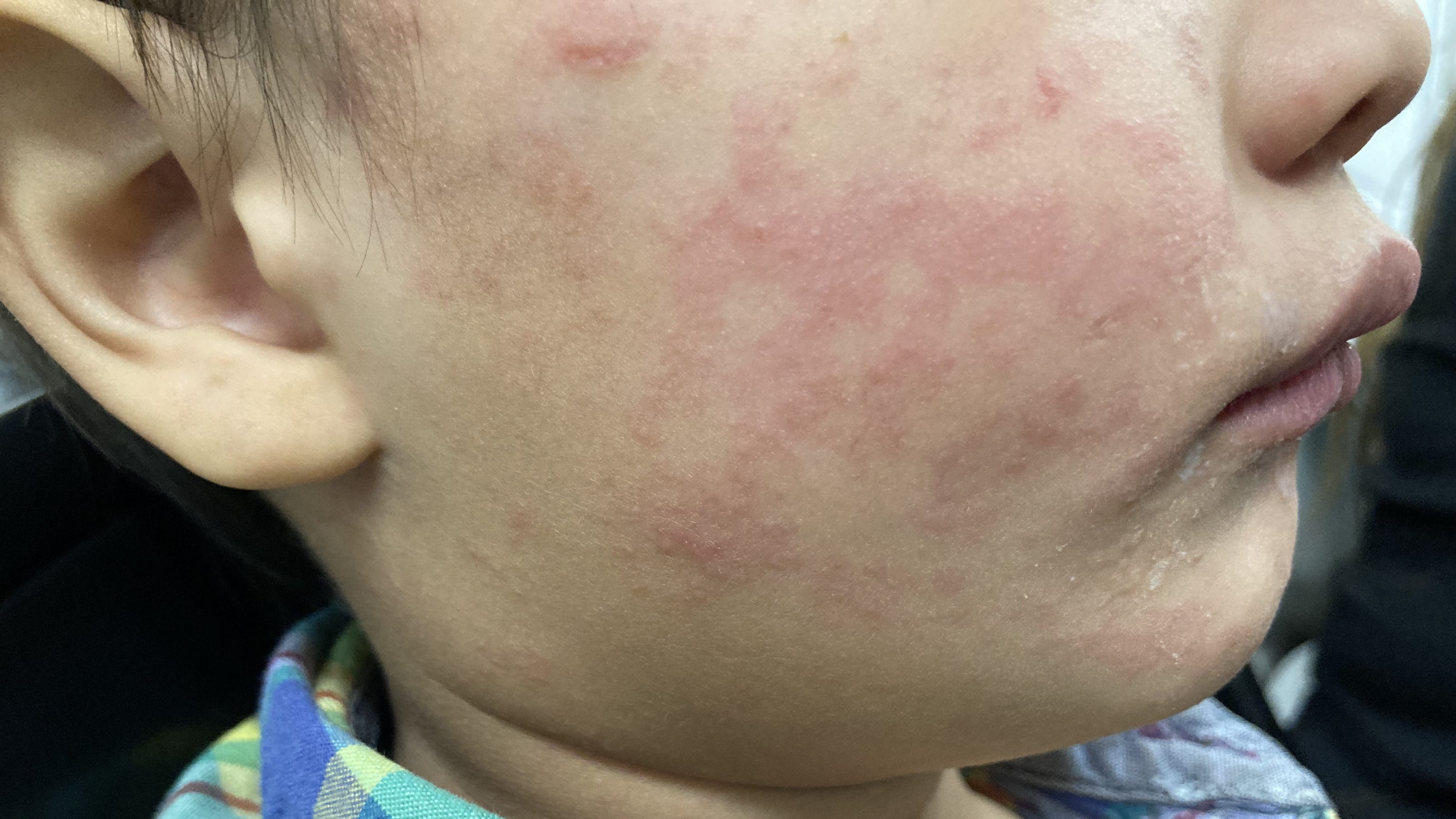 Measles Cases Rise In Kansas: Six New Infections Confirmed Measles Cases Rise In Kansas: Six New Infections Confirmed
