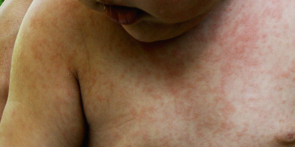 Measles Outbreak Concerns Rise In Virginia: Second Case Reported In 2025 Measles Outbreak Concerns Rise In Virginia: Second Case Reported In 2025
