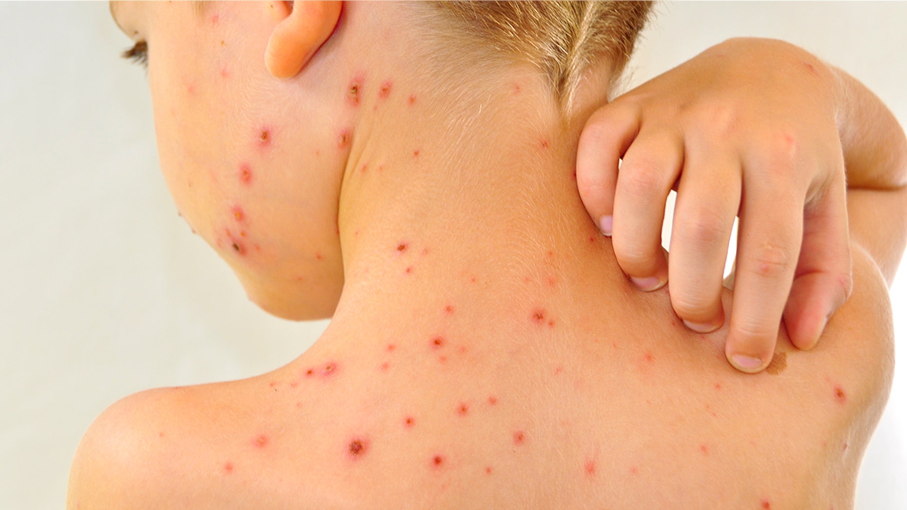 Measles Outbreak In North Dakota: School Quarantine For Unvaccinated Children Measles Outbreak In North Dakota: School Quarantine For Unvaccinated Children