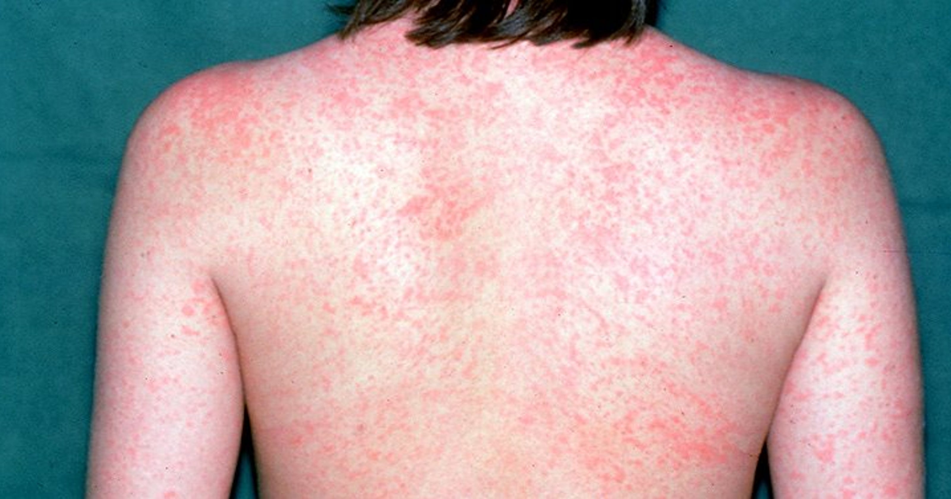 Update: 1,046 Measles Cases Confirmed In The US, Indiana Outbreak Finished Update: 1,046 Measles Cases Confirmed In The US, Indiana Outbreak Finished