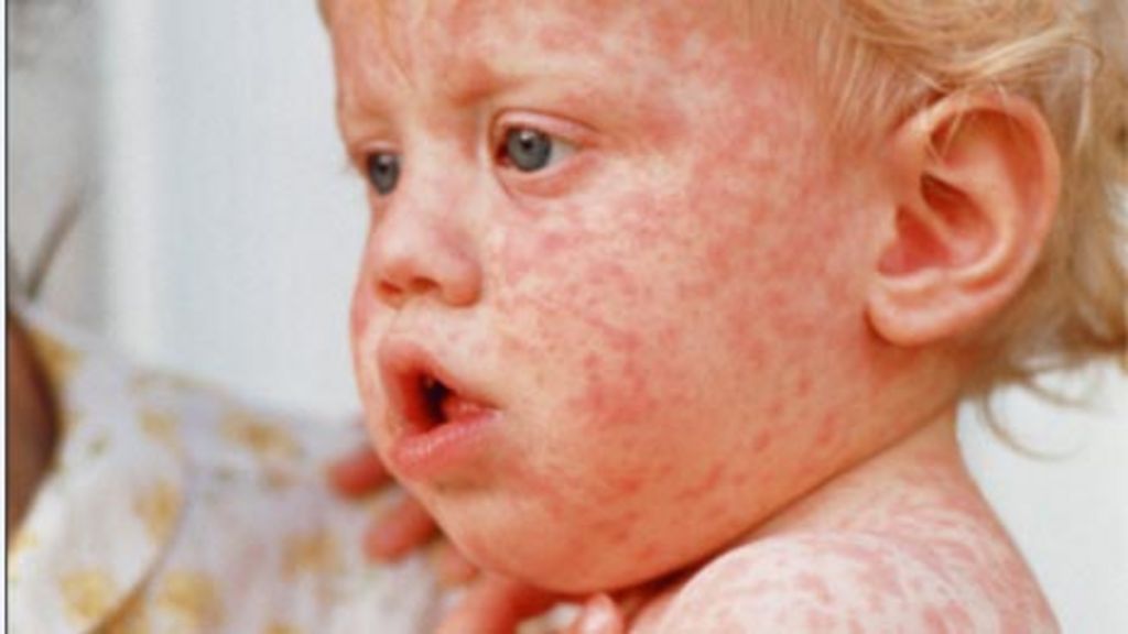 Update: Six More Measles Cases Identified In Kansas Update: Six More Measles Cases Identified In Kansas